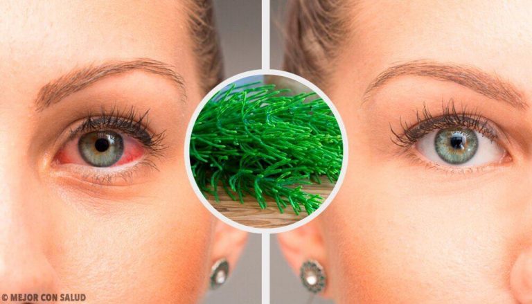 7 anbefalinger til naturligt at bekæmpe røde øjne