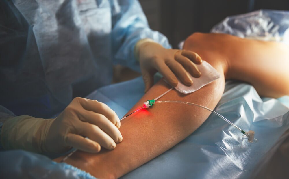 Behandling af aareknuder - hvad er aareknuder