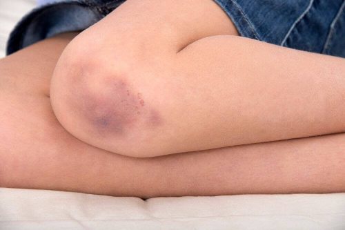 Kvinde med blaat maerke - medicinske anvendelser af vaseline