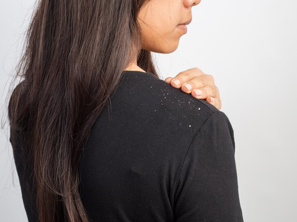 Kvinde med skael - hjemmelavet shampoo