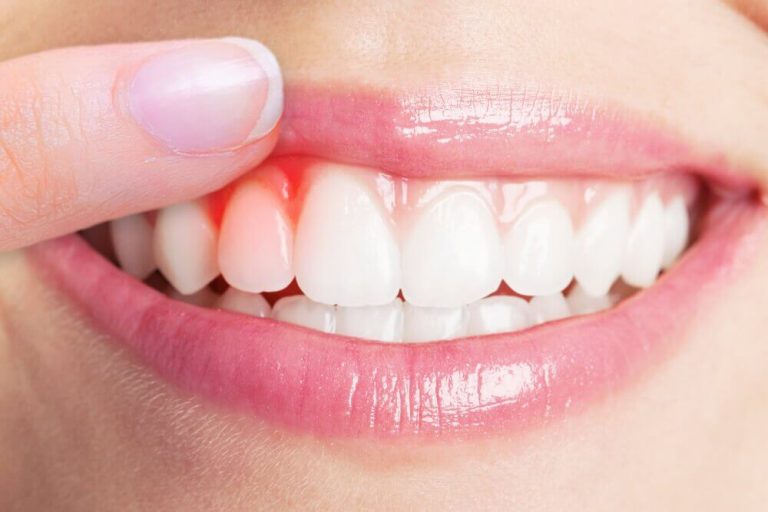Top 5 narturlige lægemidler til behandling af tandkødsbetændelse