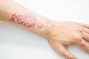 Sådan kan du håndtere psoriasis med disse naturlige midler