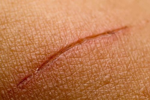 Et lille snitsaar - tidlige symptomer paa diabetes