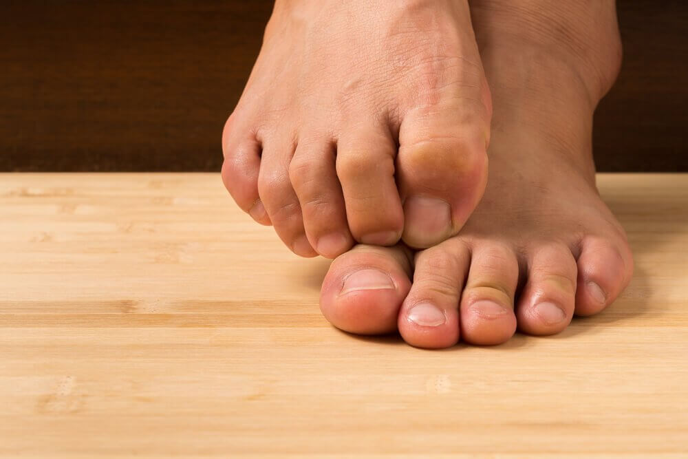 6 naturlige midler mod fodsvamp