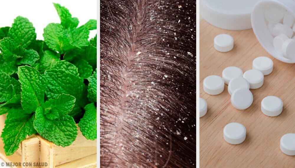 7 hjemmemidler til at behandle skæl