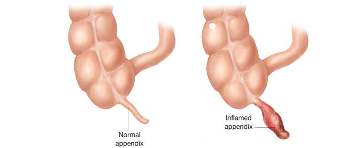 blindtarmsbetændelse