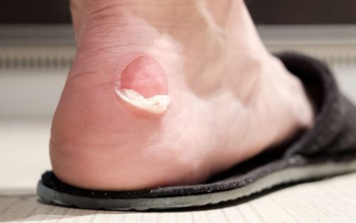 Blister fra sko
