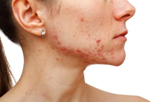 kamille mod acne