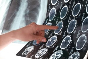 Seks forebyggende råd mod hjerneblødning