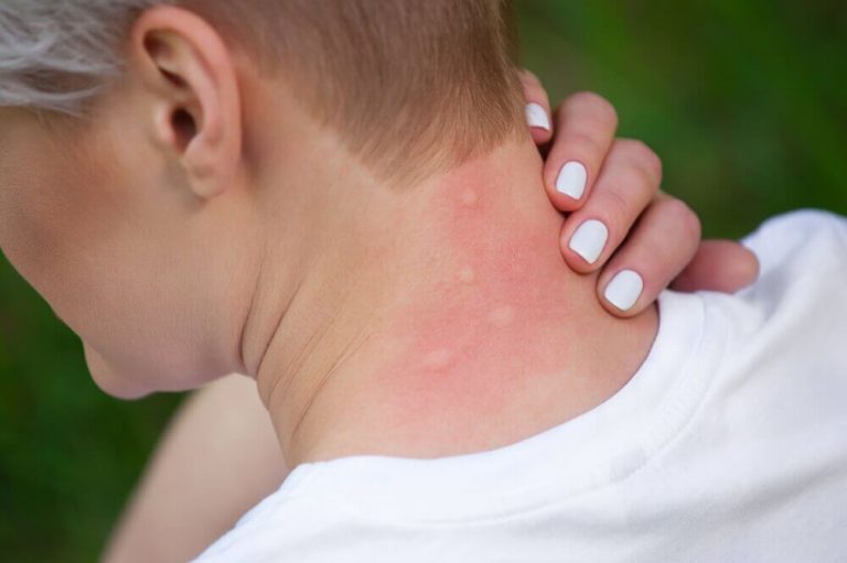 Fem midler til at lindre allergier over for insektbid