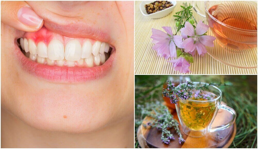 5 naturlige midler til at bekæmpe tandkødsbetændelse