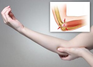 Fem naturmidler mod tennisalbue
