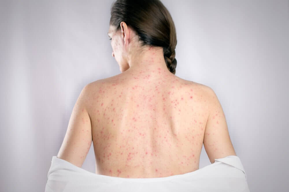 De 5 bedste midler til at kurere herpes på ryggen