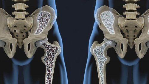 6 kosttips der kan hjælpe dig med at forebygge osteoporose