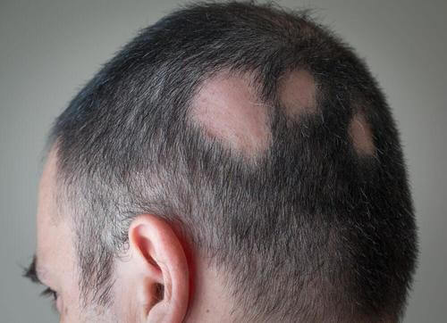 Sådan kan du behandle alopeci med naturlige løsninger