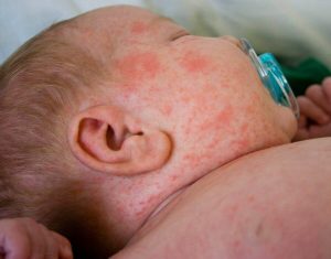 Miliaria hos babyer: Hvad gør jeg ved det?