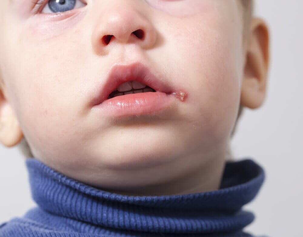 Lille barn med herpes