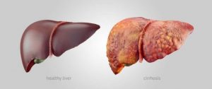 3 tips alle med levercirrose skal følge