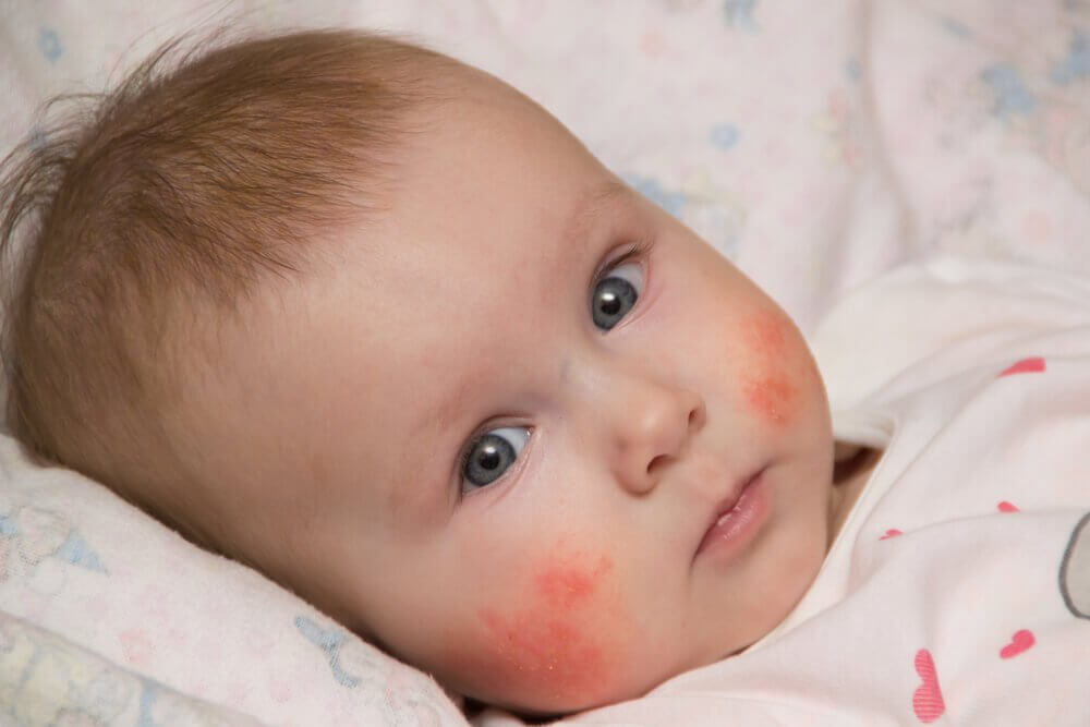 Sådan kan du lindre atopisk dermatitis symptomer