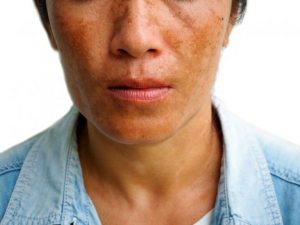 Tre behandlinger til at reducere melasma pletter