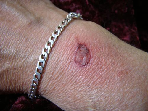 sådan kan man behandle forbrændinger