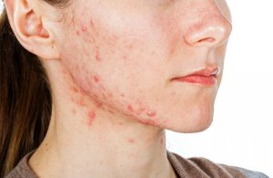6 naturlige akne behandlinger