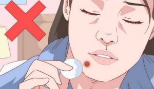 En naturlig behandling mod akne på hagen