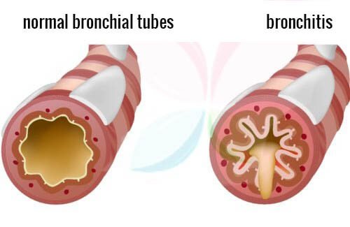 Naturlige måder til at behandle bronkitis