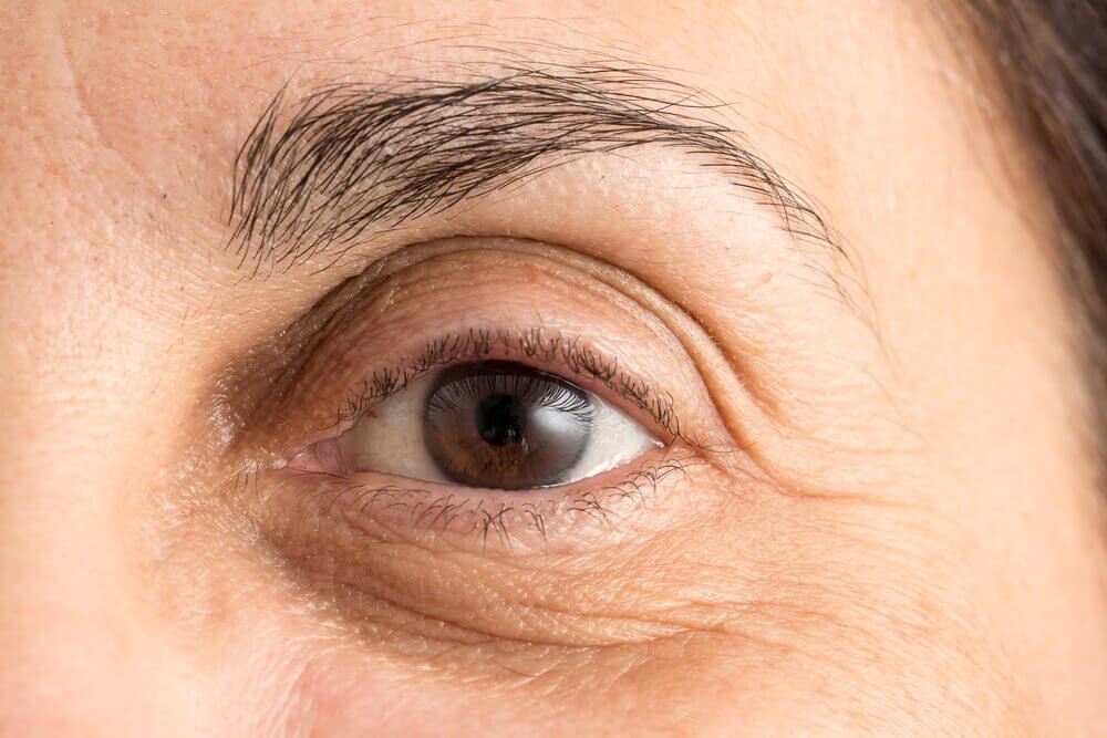 Sådan minimerer du mørke rande under øjnene: 5 naturlige metoder