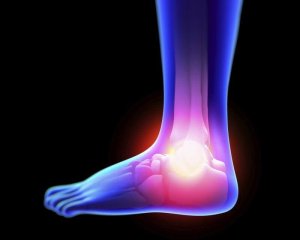 Sådan behandler du forstuvninger naturligt