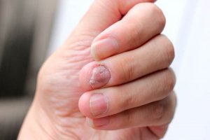 5 naturlige remedier til at behandle neglepsoriasis