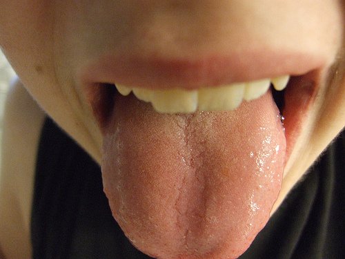 Læsioner på tungen
