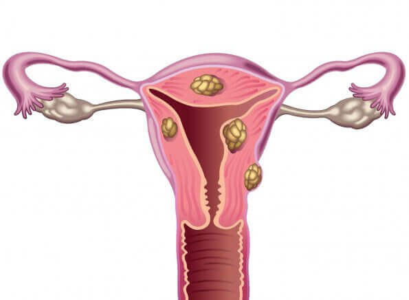 Fibroider i livmoderen