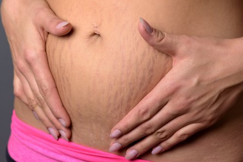 Strækmærker opstår ofte i forbindelse med graviditet