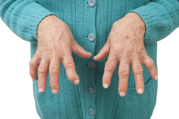 Smertelindrende midler mod reumatoid artritis
