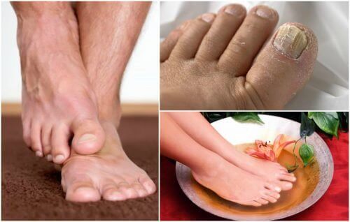 Symptomerne på fodsvamp: Har du dem?