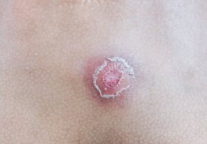 Syv husråd mod bylder