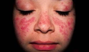 Behandling af lupus erythematosus (SLE)