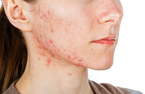 En pige med slem acne.