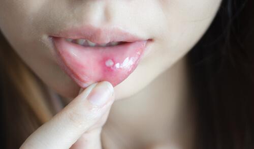 Sådan behandler du blister og mundsår