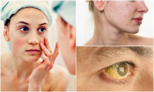7 tegn på mangel på næringsstoffer, som viser sig på dit ansigt