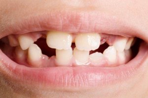 Misdannede tænder: Typer og behandling