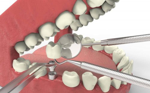 her ses hvordan man laver implantat i mund