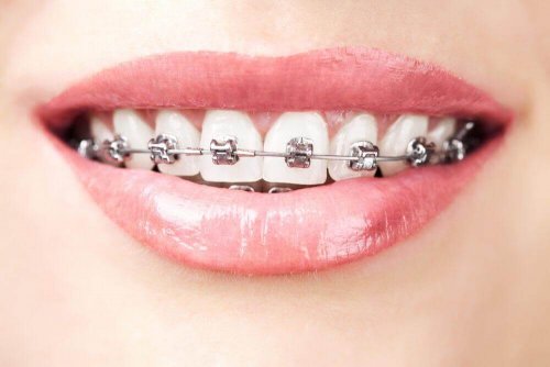 tænder med bøjler