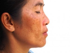 Sådan behandles melasma med yoghurt, banan og citron