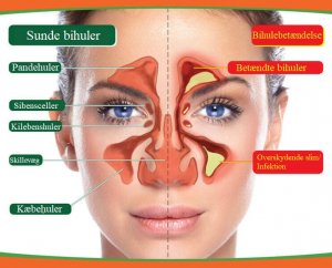 De forskellige symptomer på bihulebetændelse