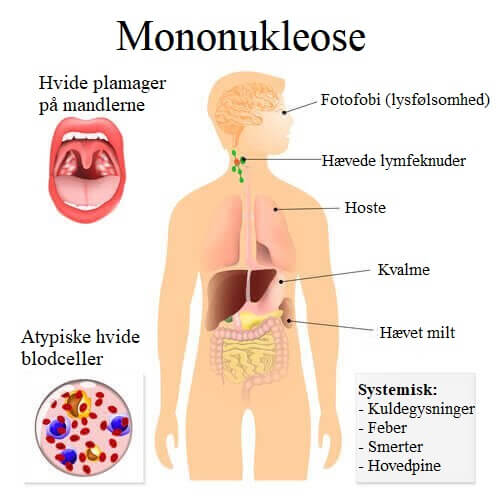 Symptomer på smitsom kyssesyge