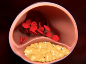 Naturlige midler til behandling af arteriosklerose