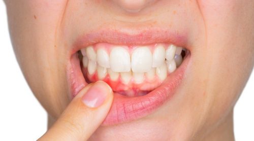Sådan kan du behandle tandbylder