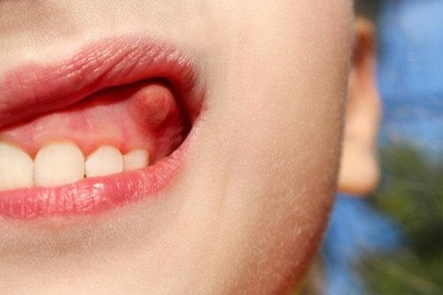 Sådan kan du behandle tandbylder med hjemmemidler